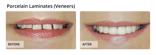 veneers before and after