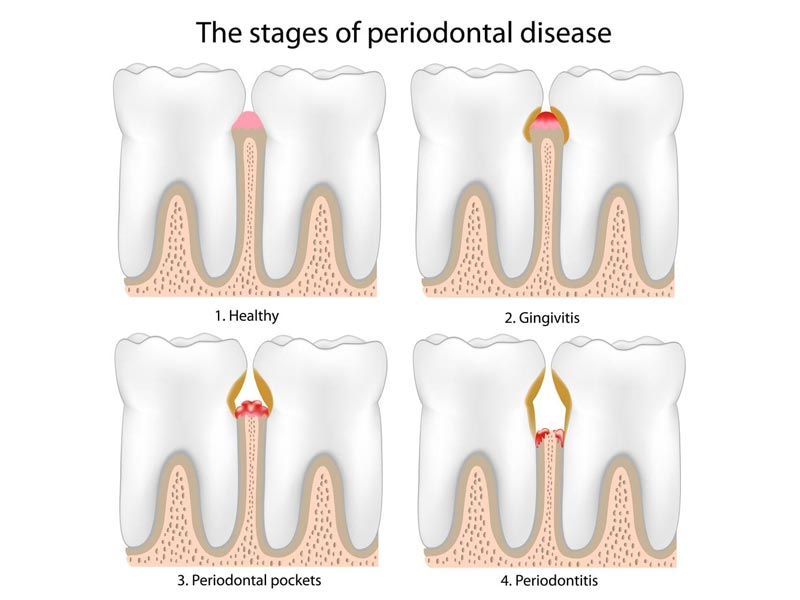 sings of periodontal disease